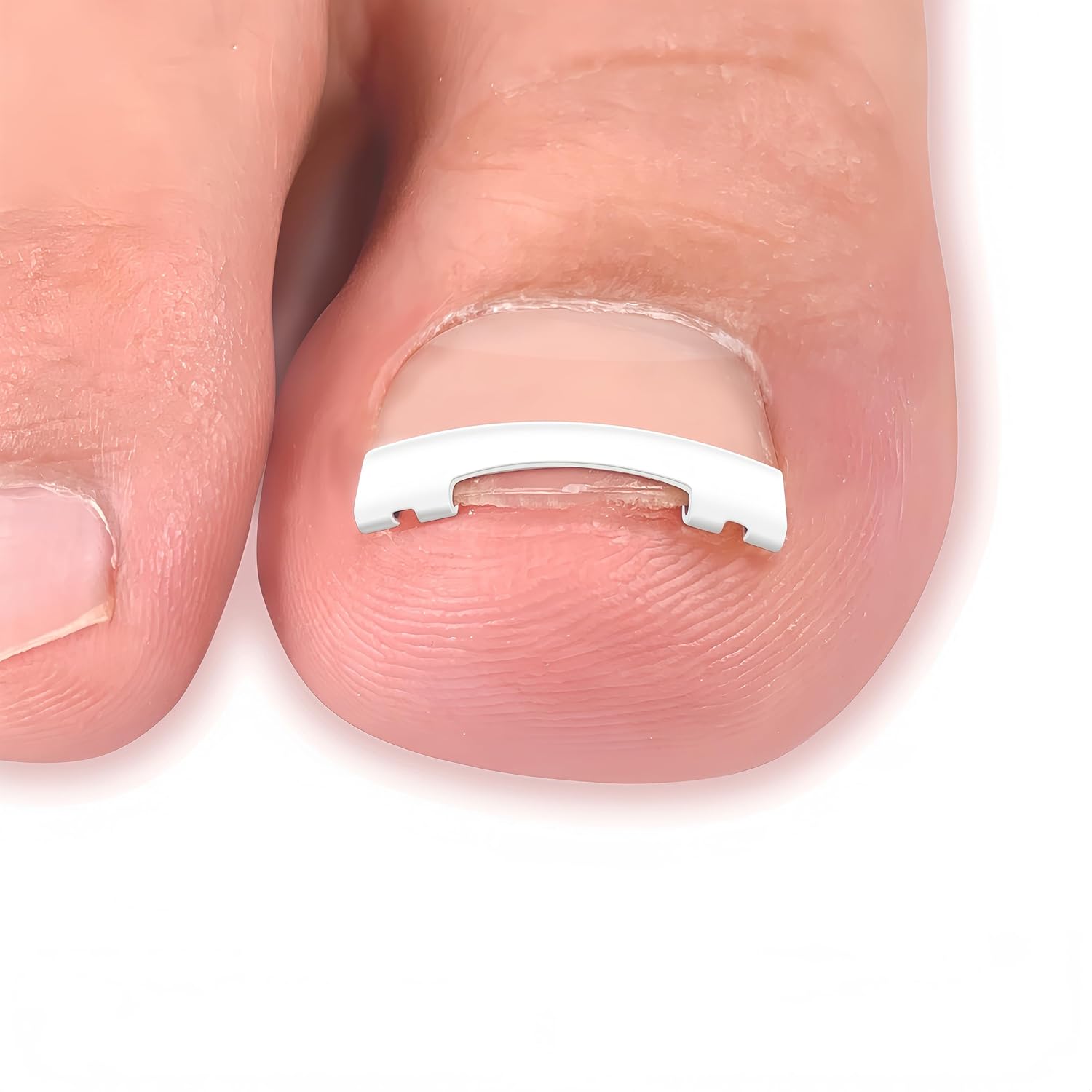 Ingrown Toenail Tools, No Glue Needed. New Titanium Alloy Toenail Corrector with 4-Claw Design offers 8x stronger pull. Safe ingrown toenail remover, unisex for men and women. Ideal for home, salon