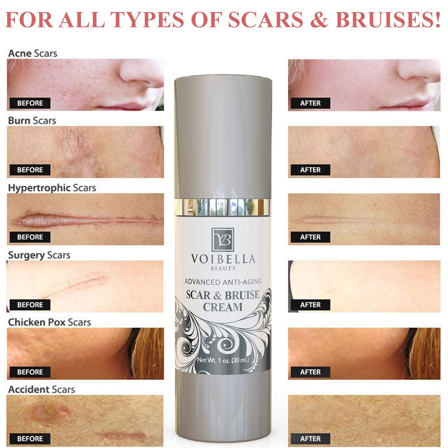 Scar & Bruise Removal Cream Best Treatment Remedy for Healing, Skin