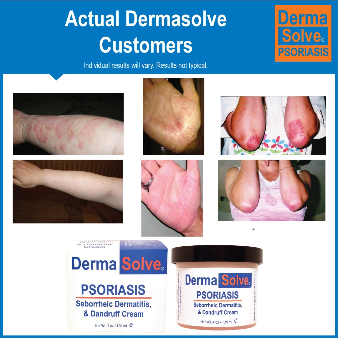 Extra Strength Psoriasis Cream Seborrheic Dermatitis & Dandruff