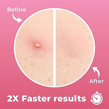 ACNE - KRK Amazon.com: TKTK Large Pimple Patches (7 Sizes 266 Patches