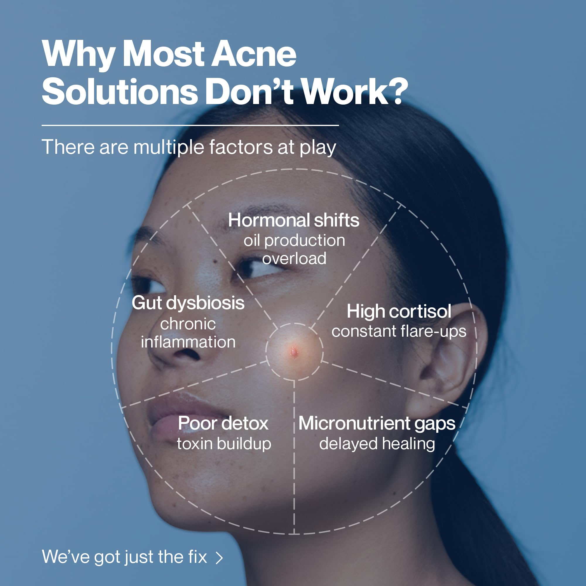 Skin: AcneClear for Gut & Hormone Support | With BIFIACNEL, Chasteberry, Chamomile & Magnesium + Supergreens & Antioxidants | Tackles Acne at the Root | 30 Sachets – Green Apple Flavor - Image 3 thumbnail