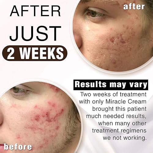 Miniatura 4 de Anna Guanche MD Miracle Cream - Tratamiento para el acné que reduce rápidamente las espinillas y el enrojecimiento