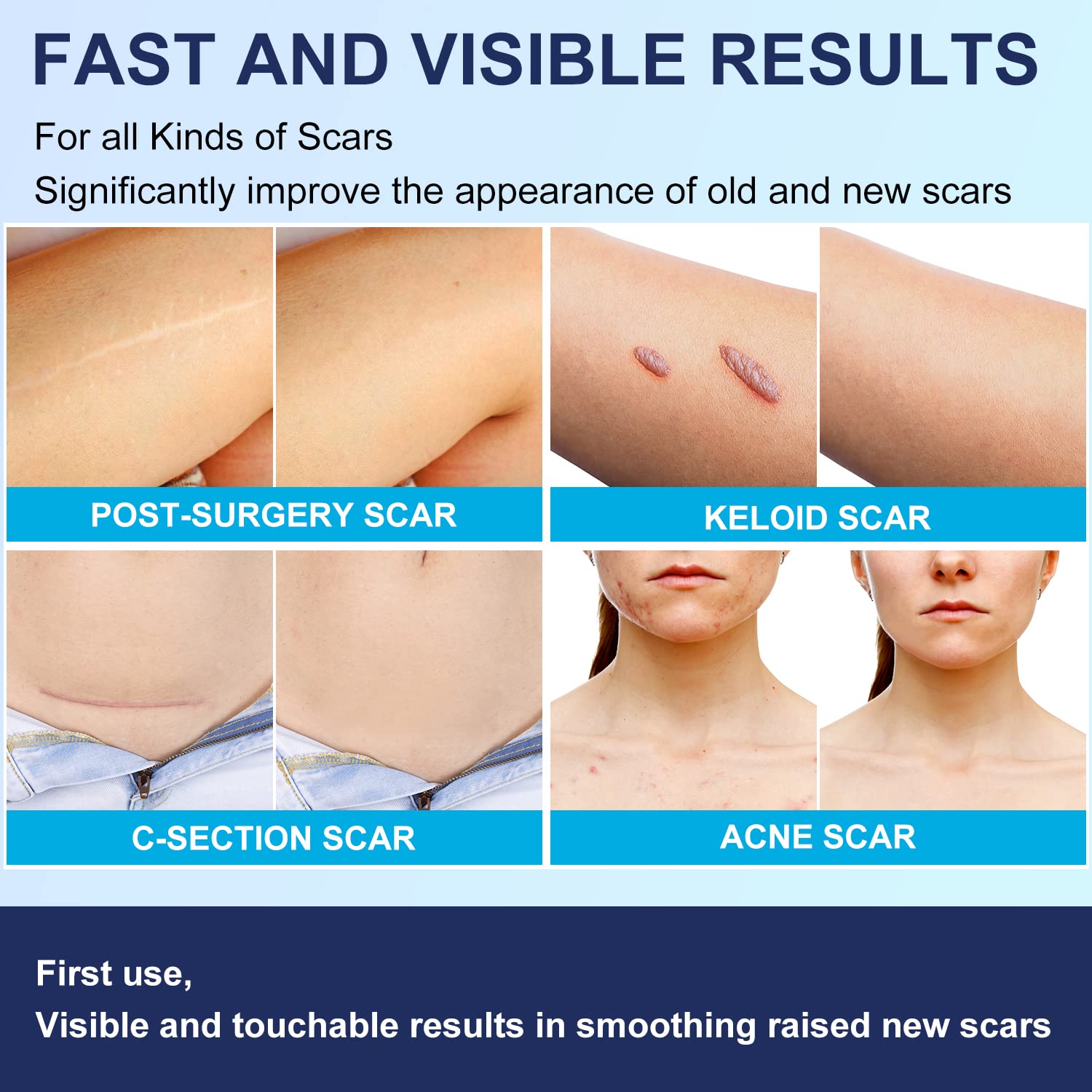 Silicone Scar Removal Sheets,(1.6”x 6”/4cm*15cm) Reusable Washable Professional Scar Removal Tape, Strips for C-Section, Surgery, Burn, Keloid, Acne, Scar Patches work on Old and New Scars