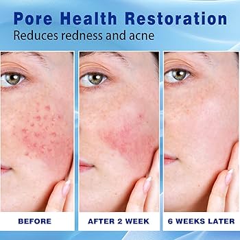 Amazon.com: Sefralls 10% Azelaic Acid Acne Cream, Premium Azelaic