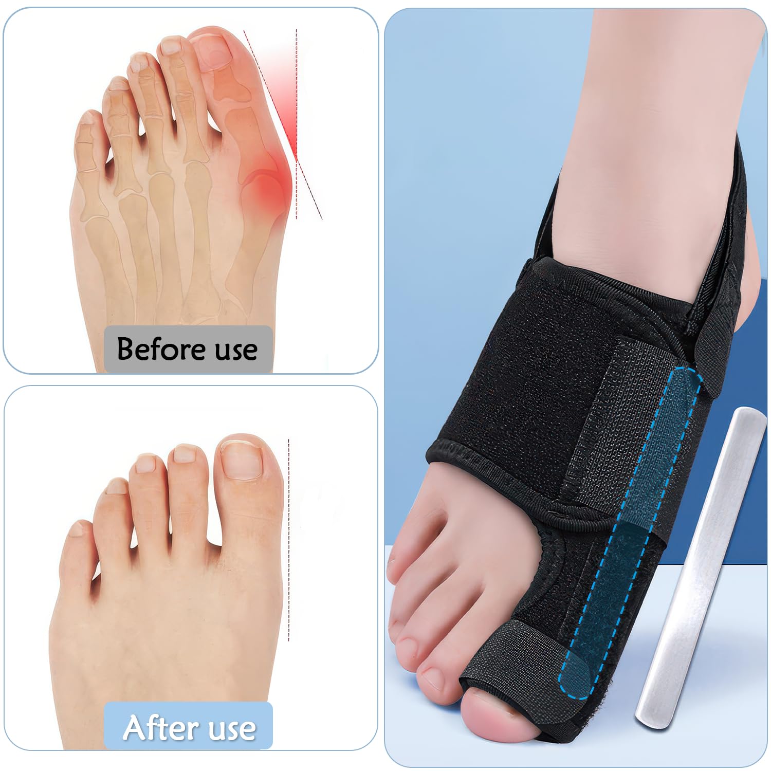 1 Paar Ballenzehen-Korrektoren, Großzehen-Glätter, Zehenspreizer, Ballenschutz, Hallux-Valgus-Korrektoren mit Aluminium-Stabstütze für Männer und Frauen