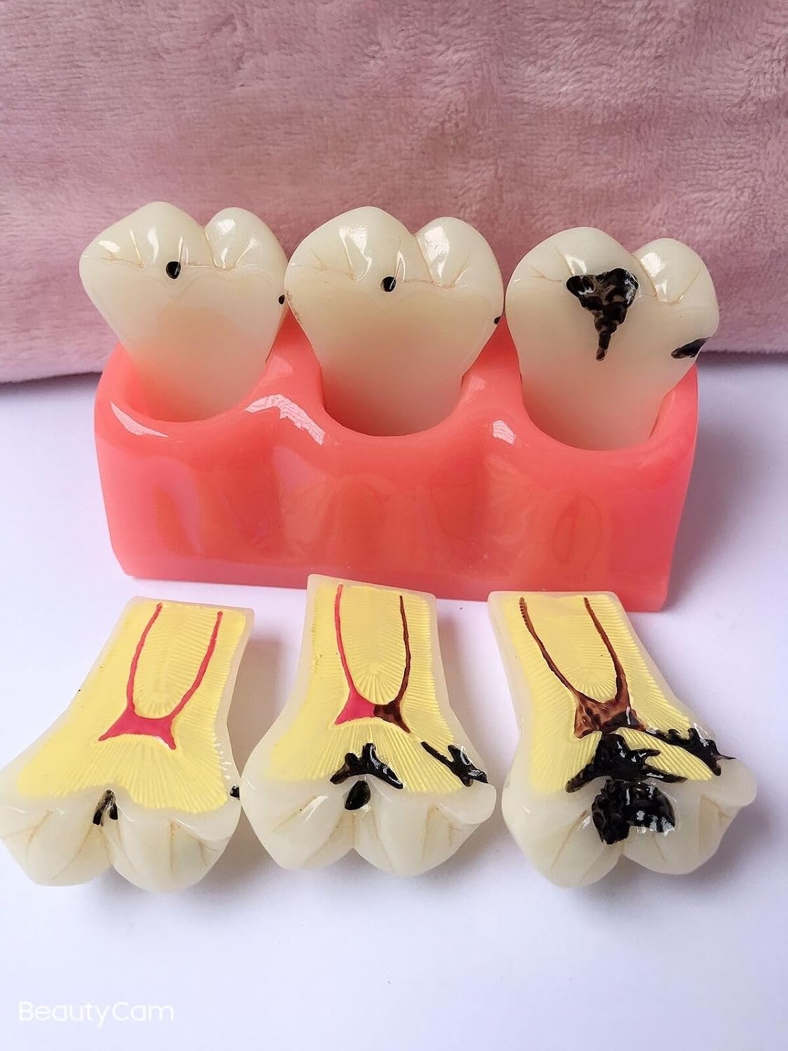 4 Times Caries Evolution Model Detachable Teeth Disease Teach Anatomy Model for Dentist Teaching Learning