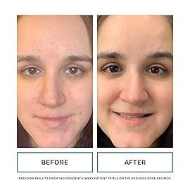 Replenix BP Acne Face Wash, 6.7 Fl Oz, Non-Oily Benzoyl Peroxide Facial Cleanser with Medical-Grade Ingredients for Acne-Prone Skin, Gently Unclogs & Refines Pores, Non-Drying & Non-Irritating