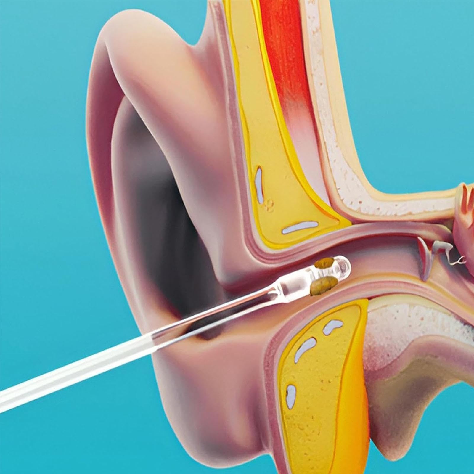 Limpiador Oidos, 24 Bastoncillos Oidos Adhesivos Con Punta Blando Lavable, Ear Cleaner, Limpia Oídos Herramientas Quitar cerumen Reutilizables Para Niños Y Adultos — view 5