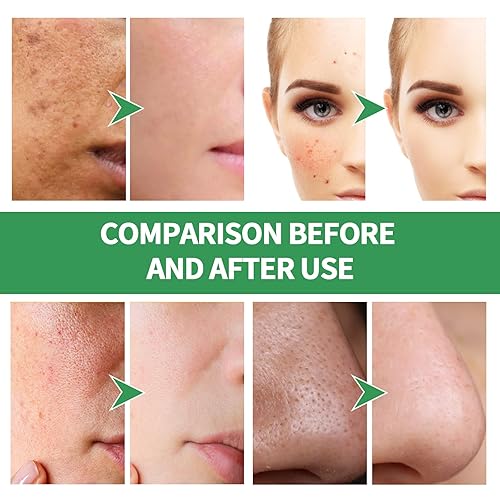 Miniatura 4 de Centella Asiatica Bubble - Máscara facial de espuma de centella, máscara facial de burbujas de centella, elimina el negro y controla el aceite,