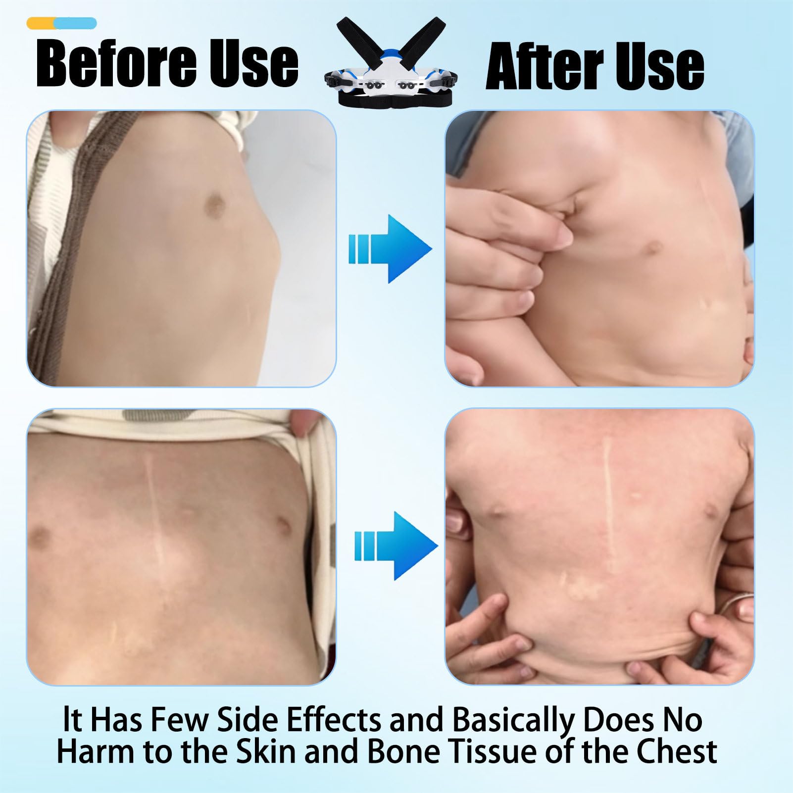 Pectus Carinatum Brace For Kids, Ribs Valgus Orthosis Braces, Soporte Pectoral Ajustable para Pecho De Paloma, Dispositivo OrtopéDico para Uso Diario