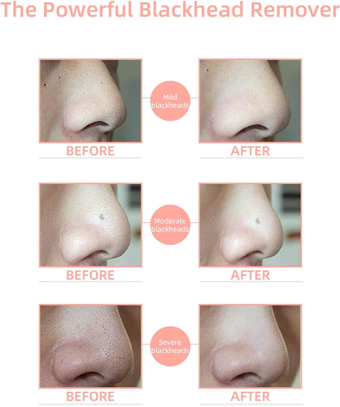 Blackhead Remover, Pore Vacuum with Camera,Acne Extractor - Blackhead Cleaner with 4 Probes and 3 Adjustable Strength Power,USB Rechargeable for All Skin : Beauty & Personal Care