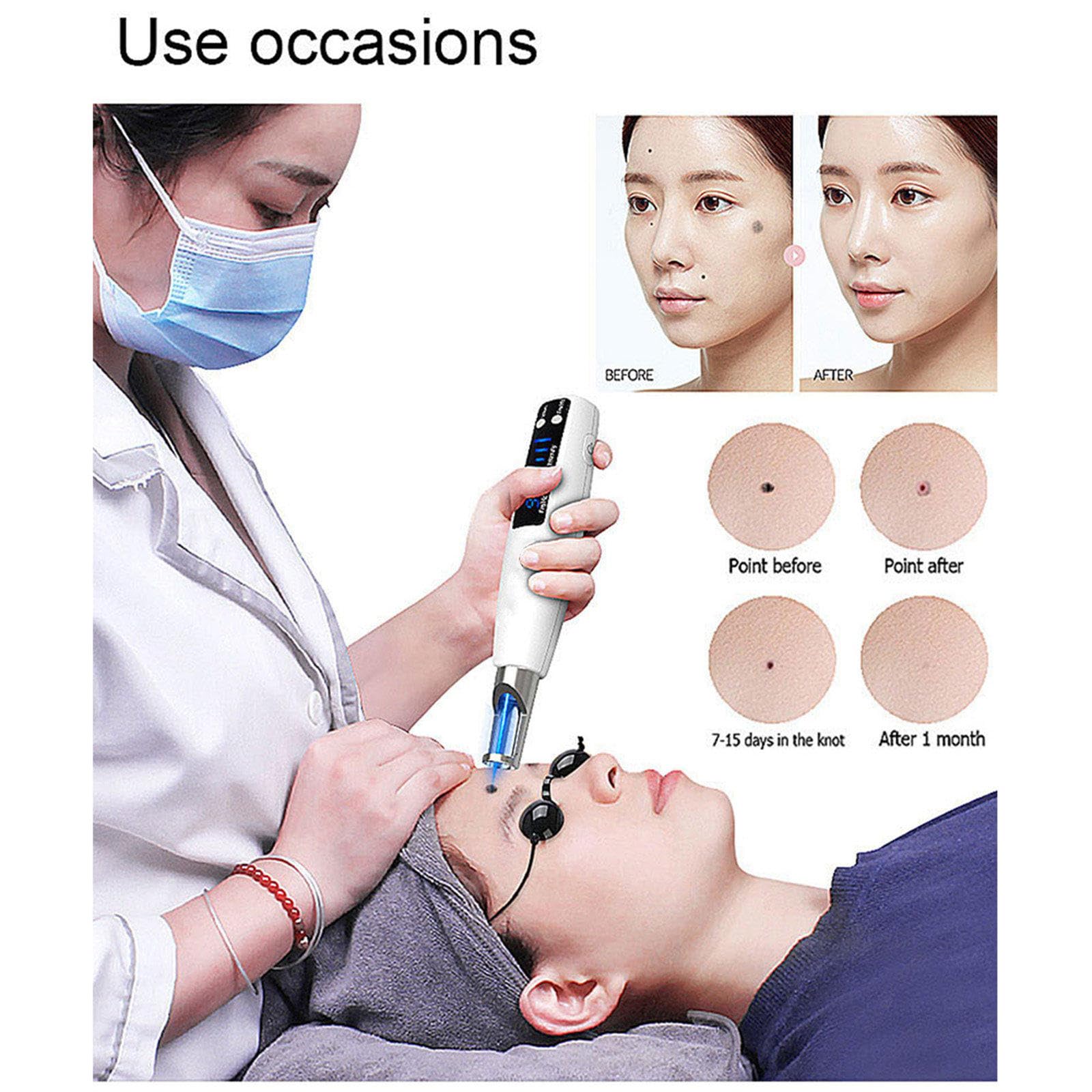 Picosecond Laser Pen, pióro do usuwania narośli skórnych, niebieskie i czerwone światło, wyświetlacz LCD, z 9 trybami, 4 poziomami usuwania przebarwień,blizn,znamion,ciemnych plam,piegów,Blue