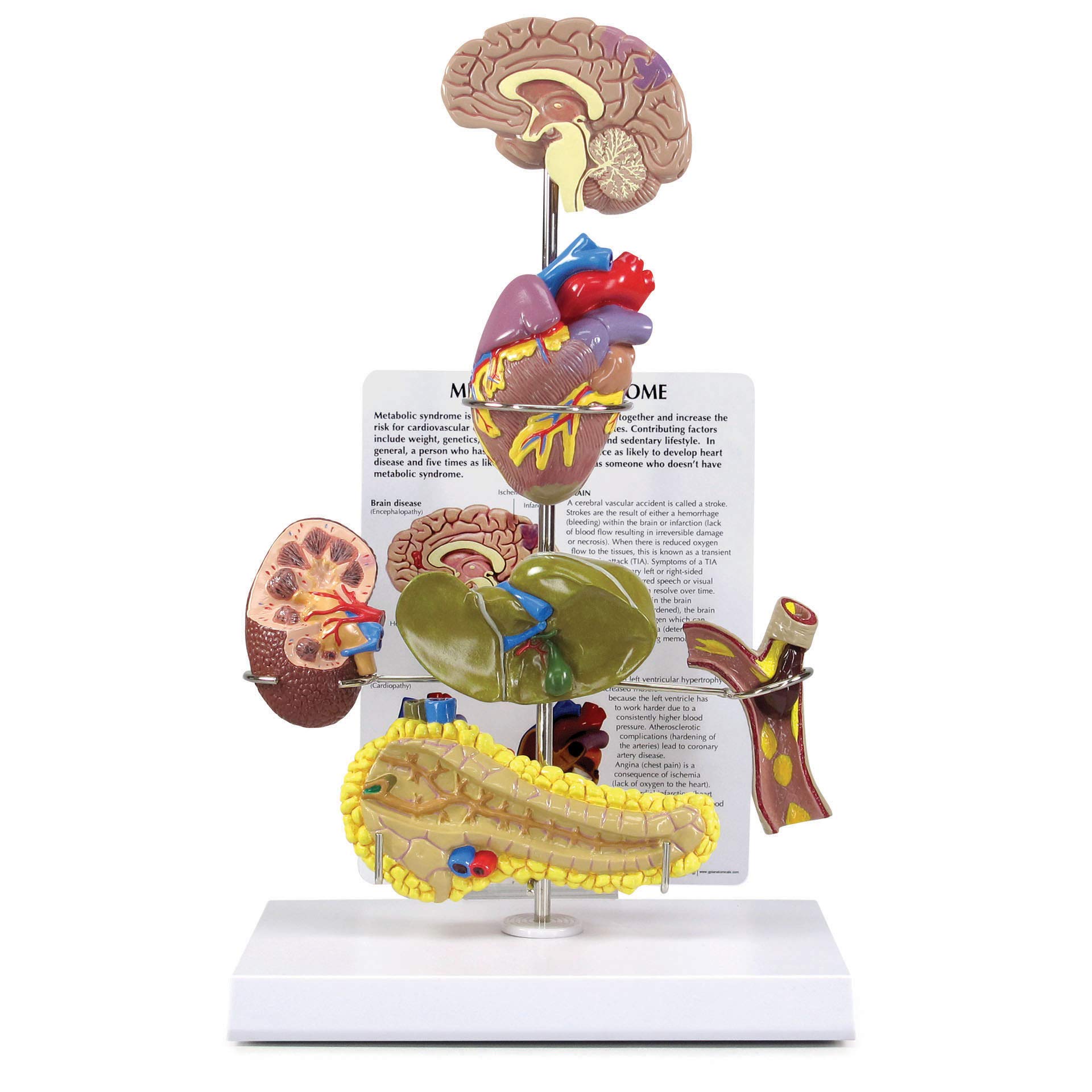 GPI AnatomicalsMetabolic Syndrome Model Set, Replica for Human Anatomy and Physiology Education, Anatomy Model for Doctor's Offices and Classrooms, Medical Learning Resources
