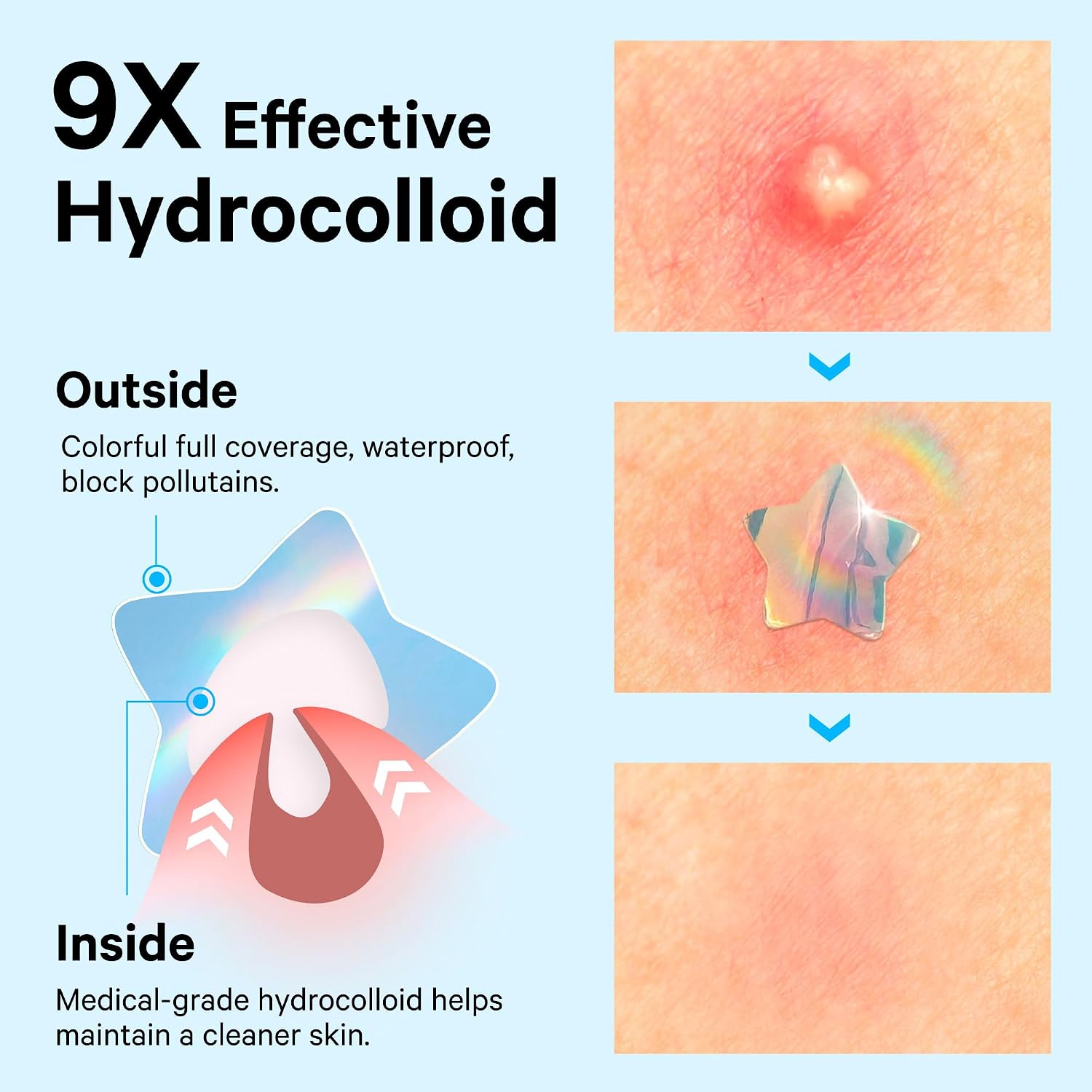 SOSKY Holographic Star Pimple Patches, Hydrocolloid Acne Patches, 144 Count Blue Star Heart Moon Cloud Butterfly Flower
