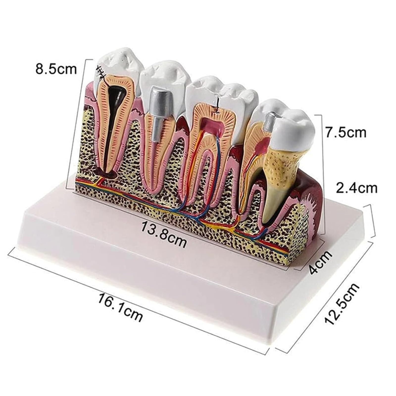 Modèle de dents d'éducation en anatomie dentaire – Modèle de section transversale des dents avec gencives dentaires amovibles pour affichage de pathologie, parfait pour les étudiants et les