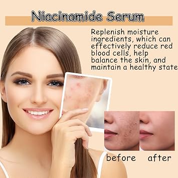 Niacinamide Serum for Face – 10% Anti-Aging Serum, Reduces Dark Spots & Evens Skin Tone, Pore Minimizer & Blemish, Hydrating Facial Essence Glowing Skin for All Skin Types, 30ml