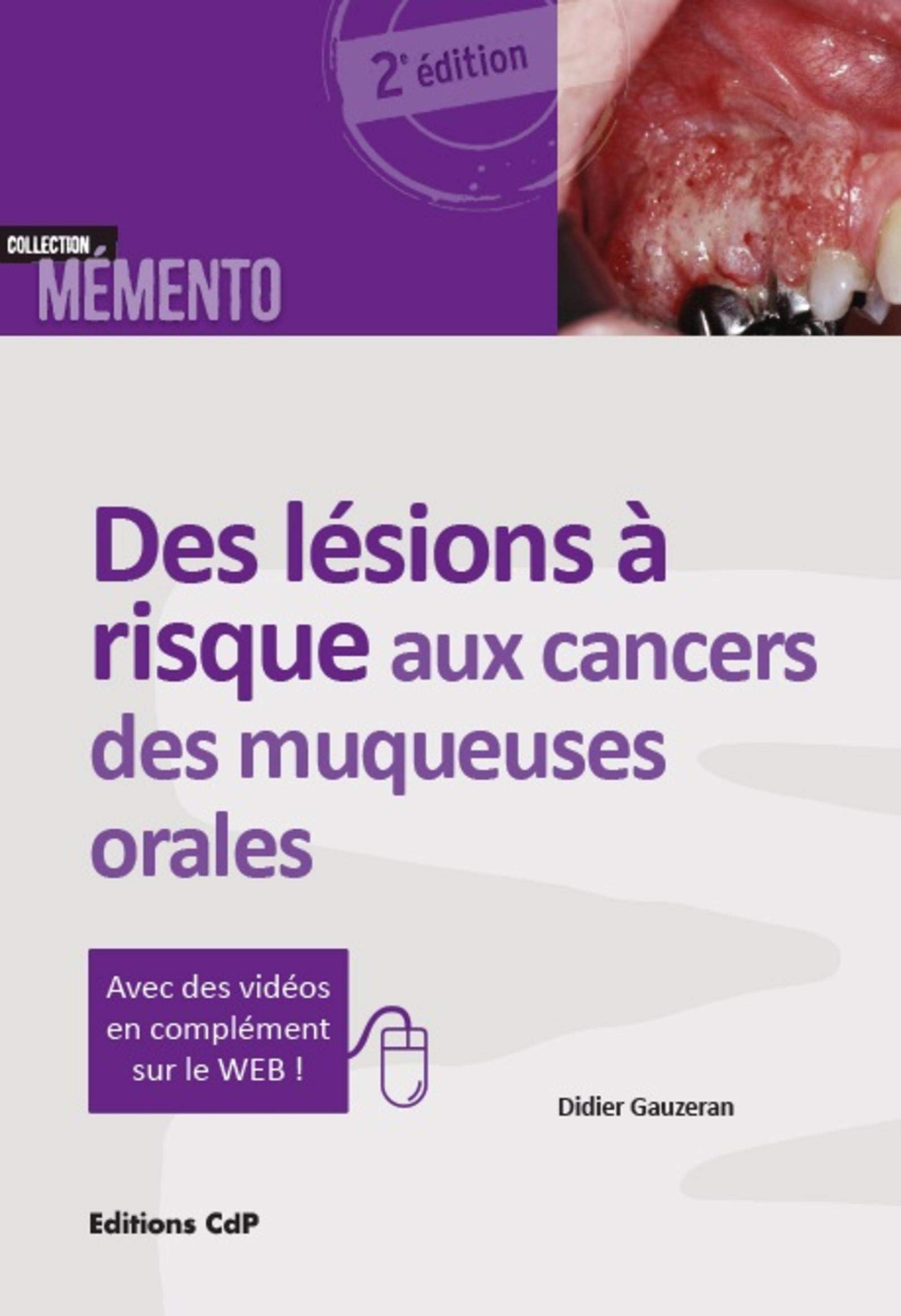 Des lésions à risque aux cancers des muqueuses orales: Avec des vidéos en complément sur le Web !