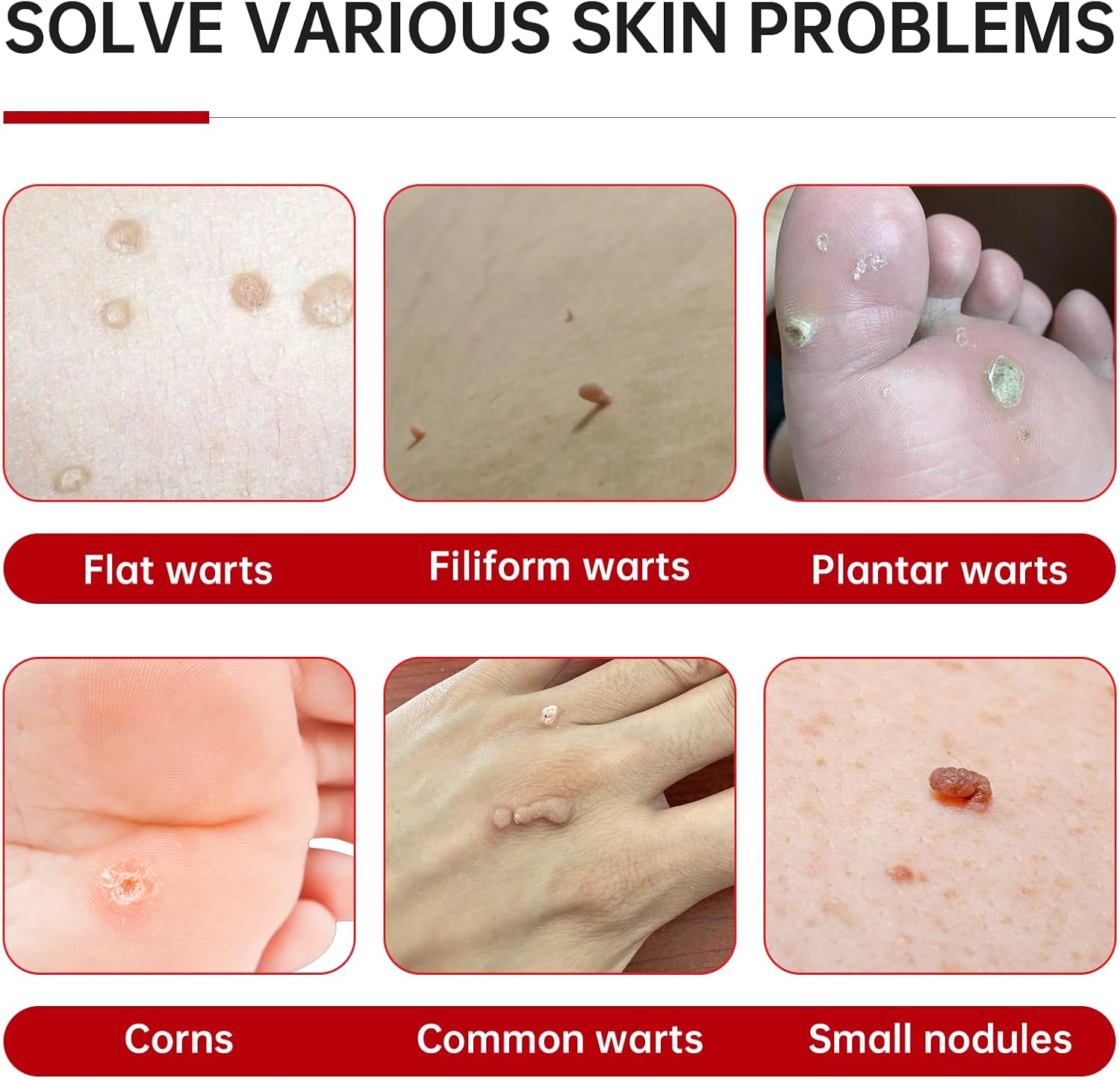 20% Salicylic Acid Wart Remover Liquid, Zero Pain Wart Remover for Plantar, Common, Flat Wart, Foot Corn for Multiple Parts of Body (Pack of 1) - Image 3