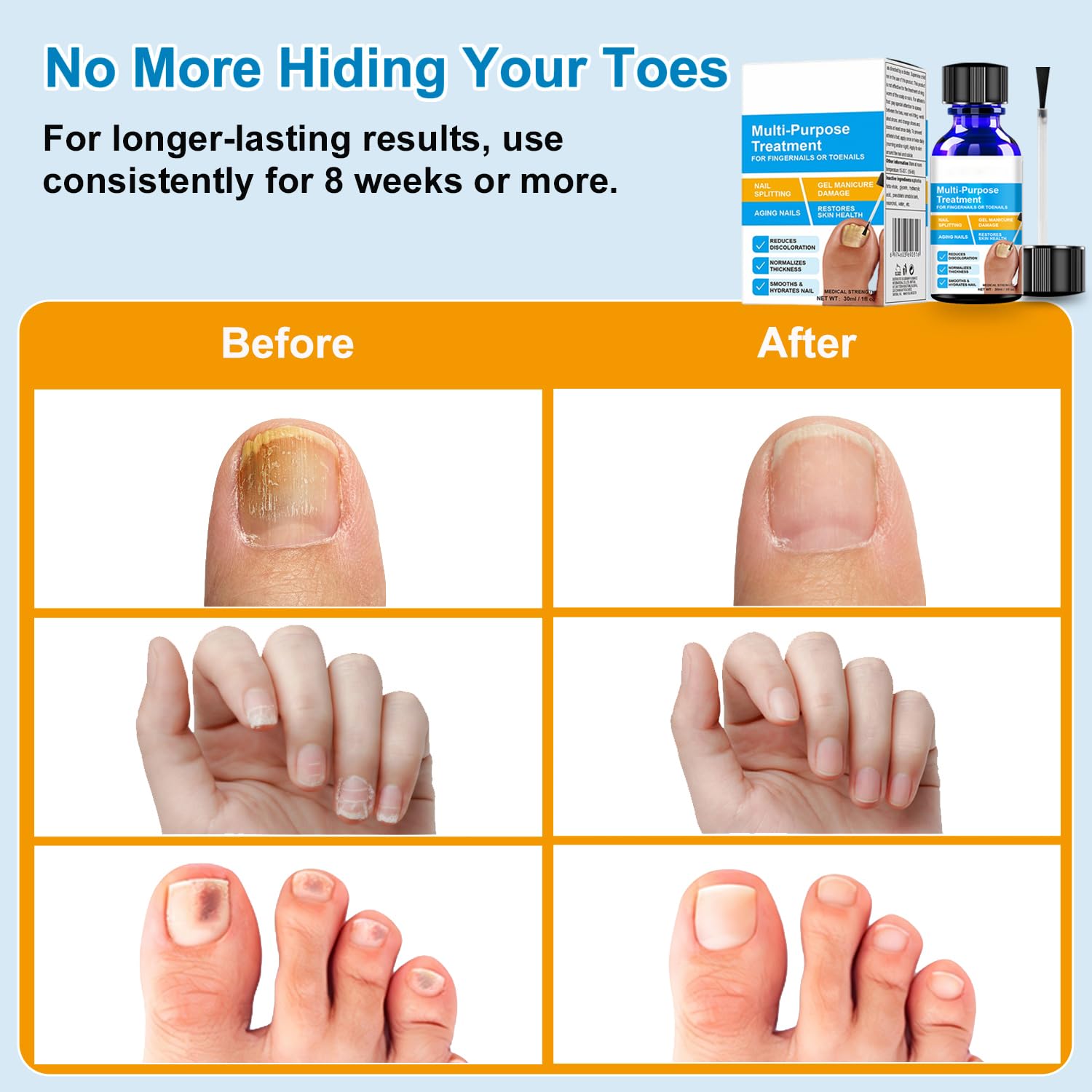Nail Fungus Treatment – Antifungal Nail Solution for Thick, Discolored Toe Nail Fungus Treatment Extra Strength with Precision Brush – 1 fl oz — view 4