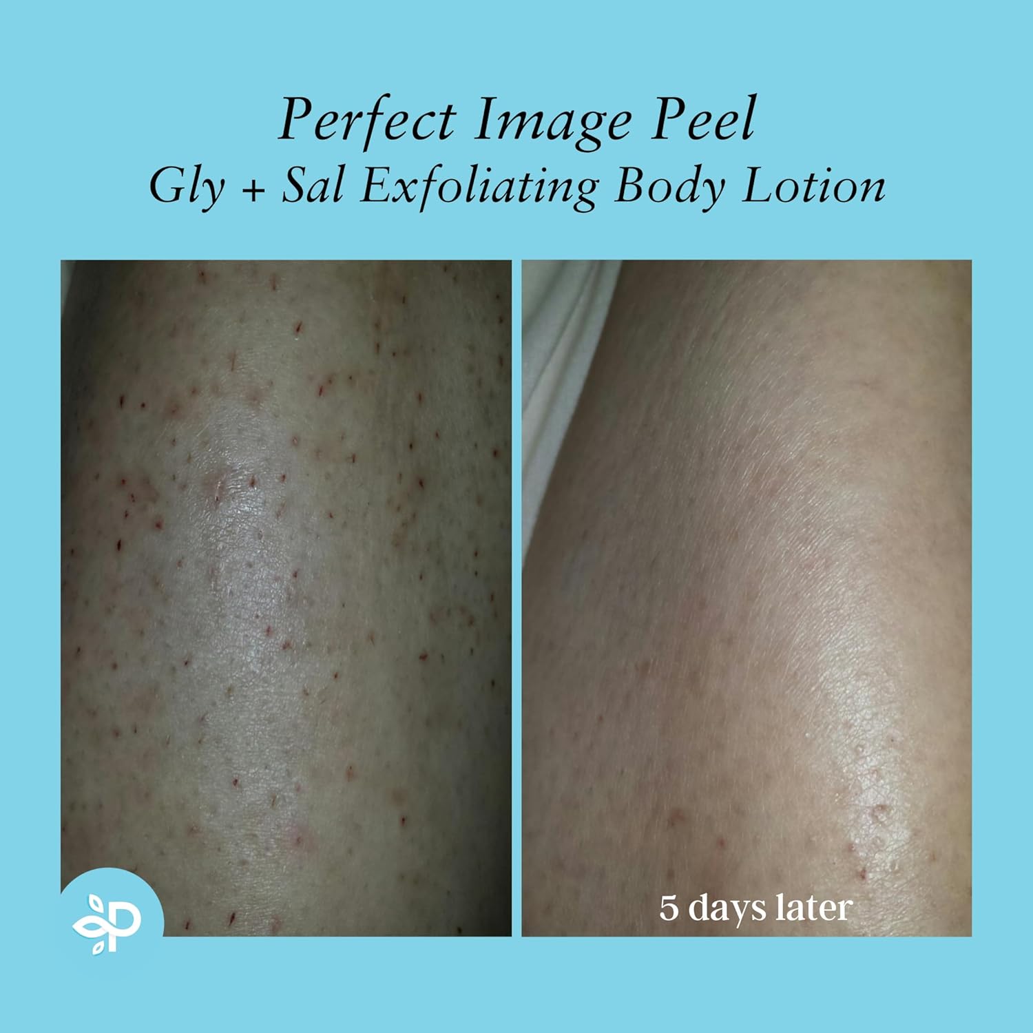Perfect Image Gly + Sal Exfoliating Body Lotion, 8% Glycolic Acid and 2% Salicylic Acid Lotion Enhanced with Green Tea, Papaya, Bearberry, Licorice and Amino Complex - Image 8