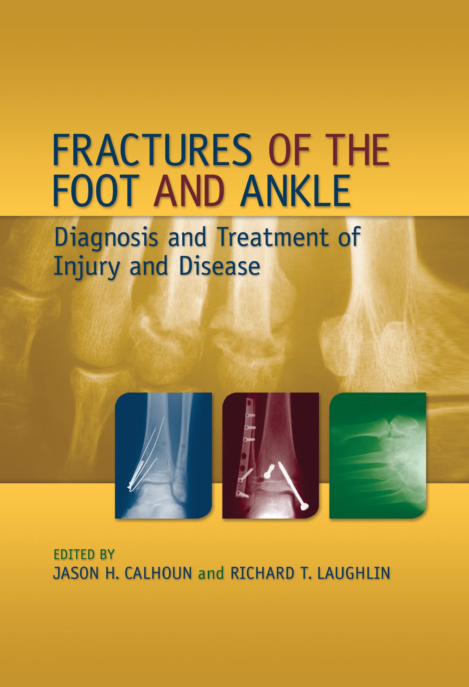 Buy Fractures of the Foot and Ankle Diagnosis and of Injury and