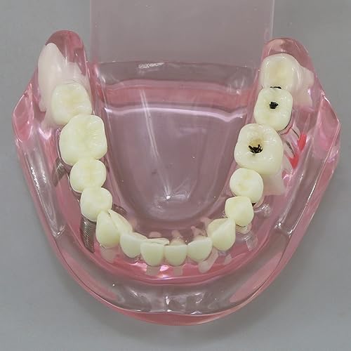 Miniatura 9 de Dental Dental Dental Modelo de Dientes de Restauración de Implantes Puente Demostración Enseñar Estudio Patología Oral Typodont para Enseñar Estudio