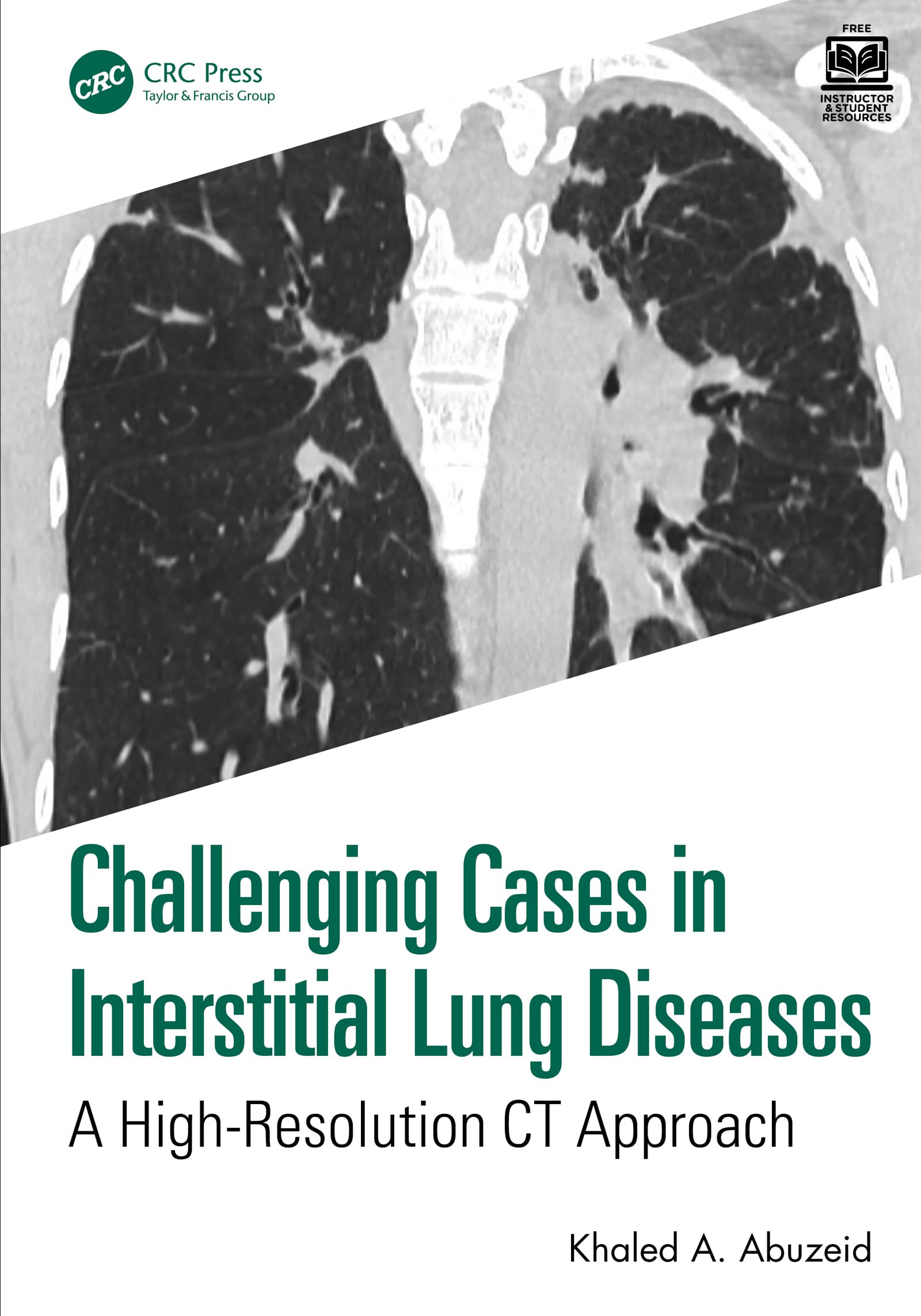 Challenging Cases in Interstitial Lung Diseases: A High-Resolution CT Approach (English Edition)
