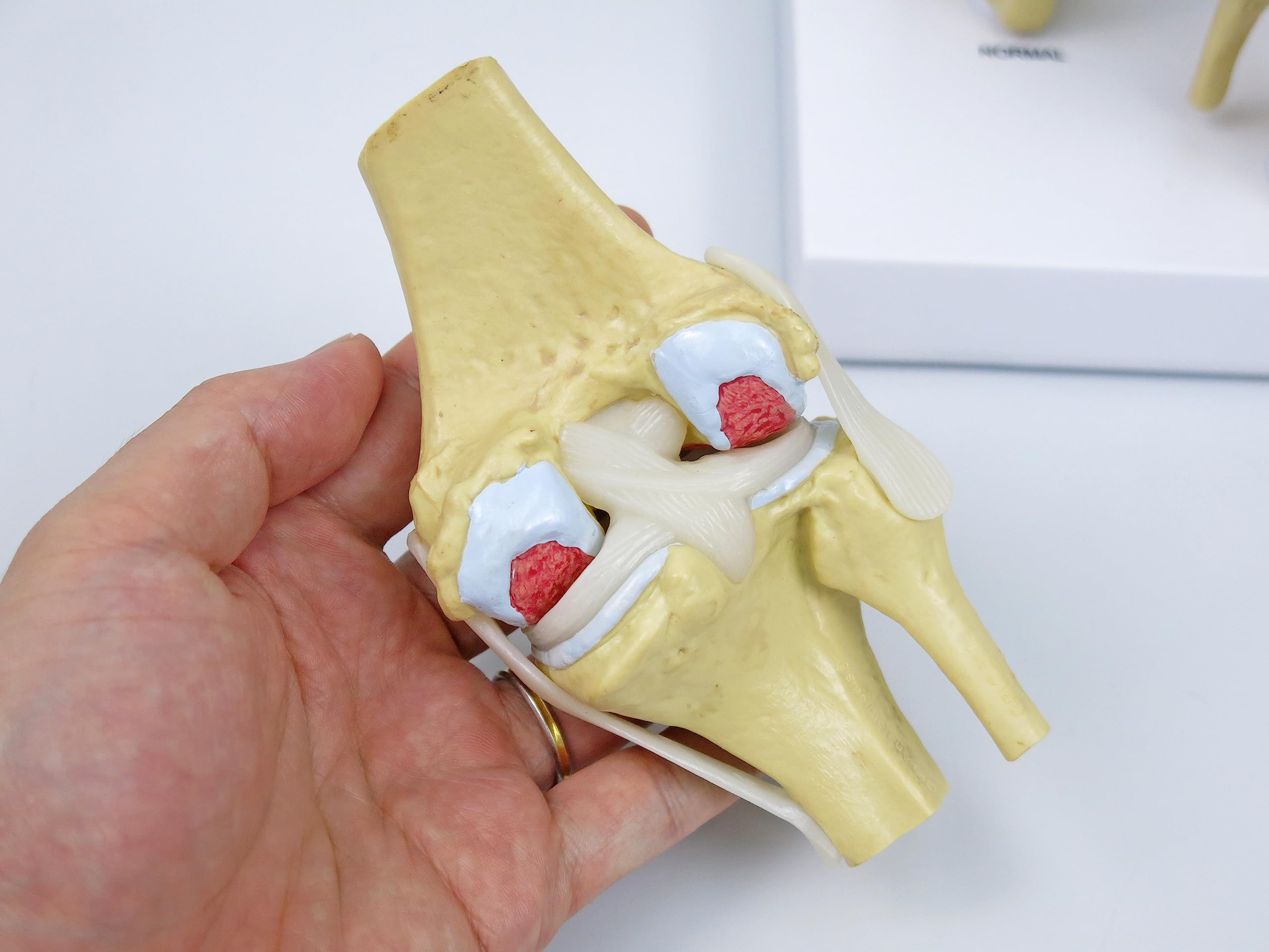 GPI Anatomicals 1100 Osteo-Kniemodellset 4 verschiedener Stadien