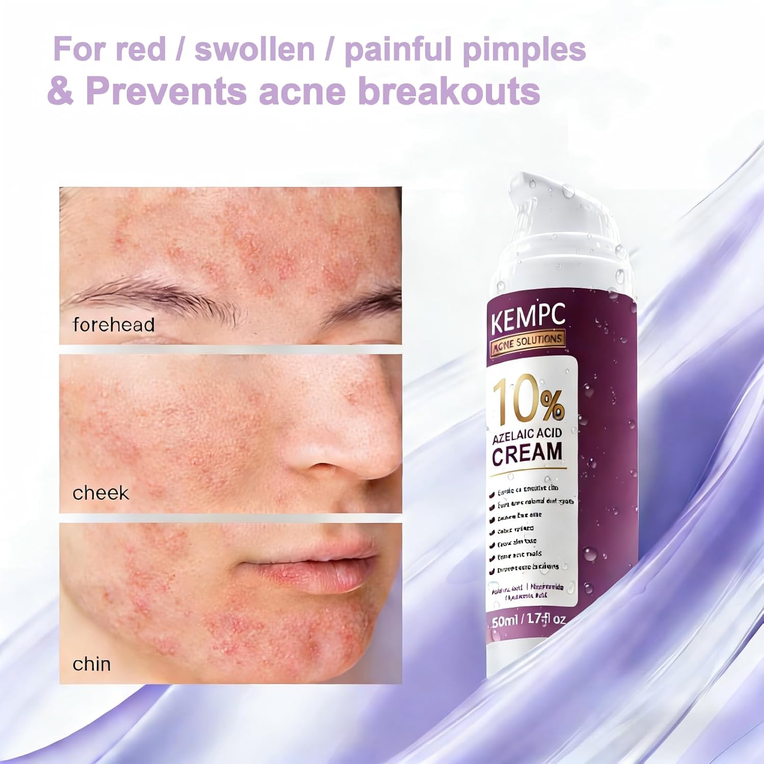 Cystic Acne Treatment for Face – Hormonal Acne Spot Treatment Pimple Cream with Azelaic Acid | Redness Reducing Acne Moisturizer for Rosacea & Sensitive, Acne-Prone Skin | Teens & Adults, 1.7 oz