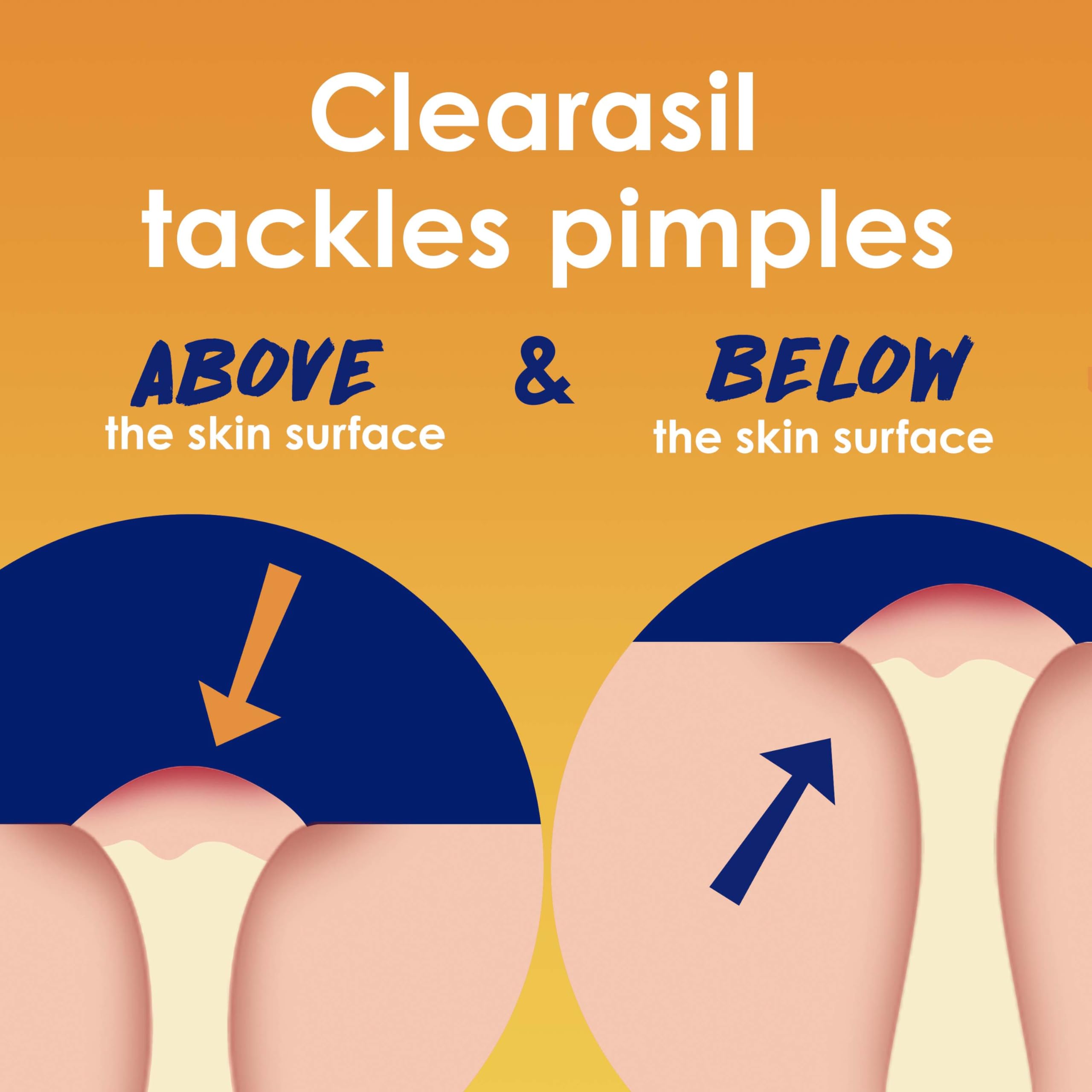 Clearasil İnatçı Akne Kontrolü 5'i 1 Arada Eksfoliye Yıkama 6.78 fl. oz., Blok Gözenekleri Azaltır, Sivilce Boyutu, Aşırı Yağ, Akne İşaretleri, Siyah Noktaları