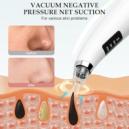 Miniatura 3 de Aspiradora facial para eliminar puntos negros, limpiador de poros y extractor de puntos negros con 3 niveles de succión ajustables, 5 sondas, kit de