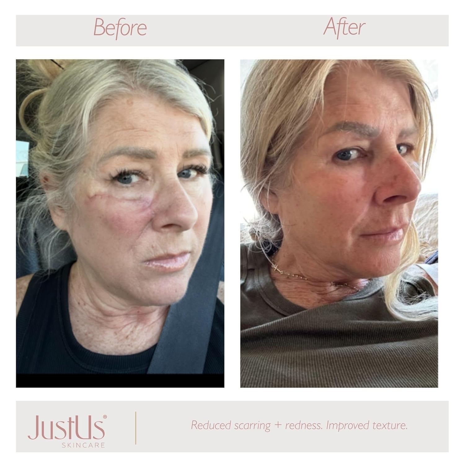 JustUs Skincare, Restore + Repair Face Oil, powerful serum to calm redness and smooth texture from scarring, visibly restore balance, infused w/Bakuchiol, Acai, Tamanu + Andiroba - 30ml / 1oz - Image 7