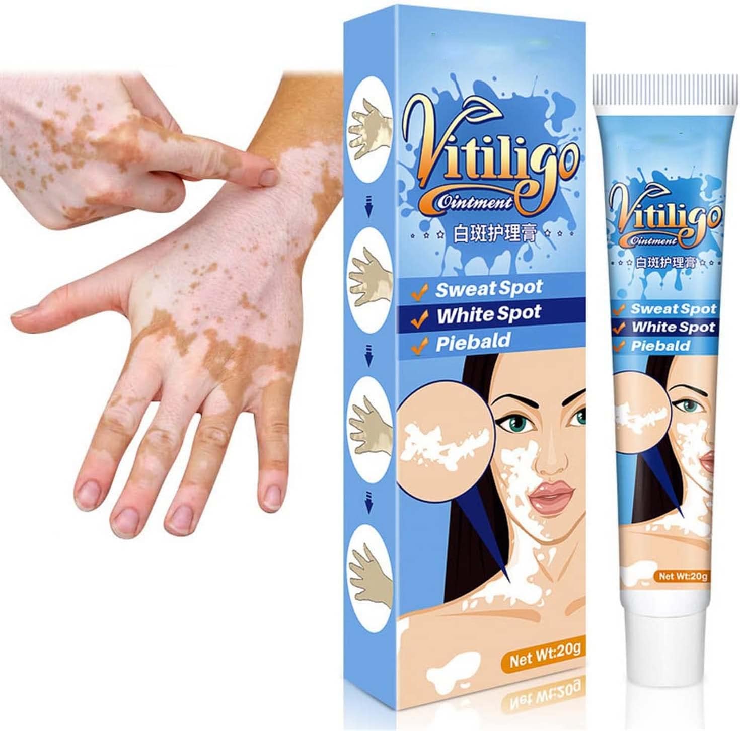 Vitiligo Cream, Vitiligo Treatment, Vitiligo Care Cream, Vitiligo Cream for White Spots on Skin, Reduces White Spots on Skin and Improve Skin Pigmentation (2Pcs)