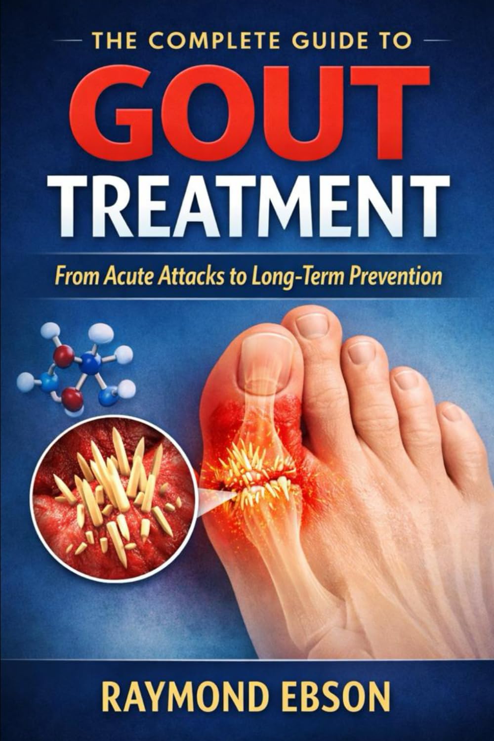 The Complete Guide to Gout Treatment: From Acute Attacks to Long-Term Prevention
