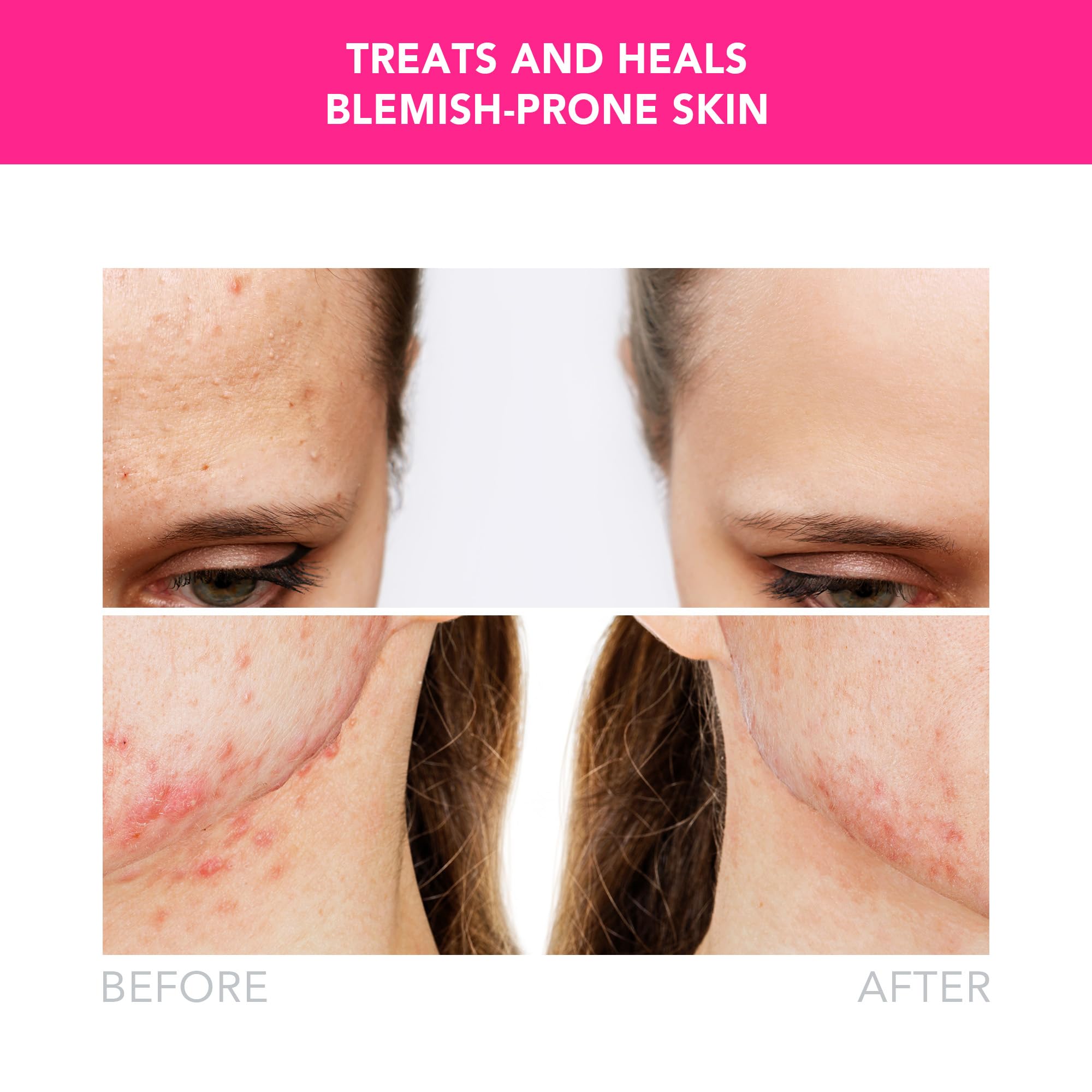 Amazon.com: FOREO ESPADA 2 LED Light Device - Blemish Treatment