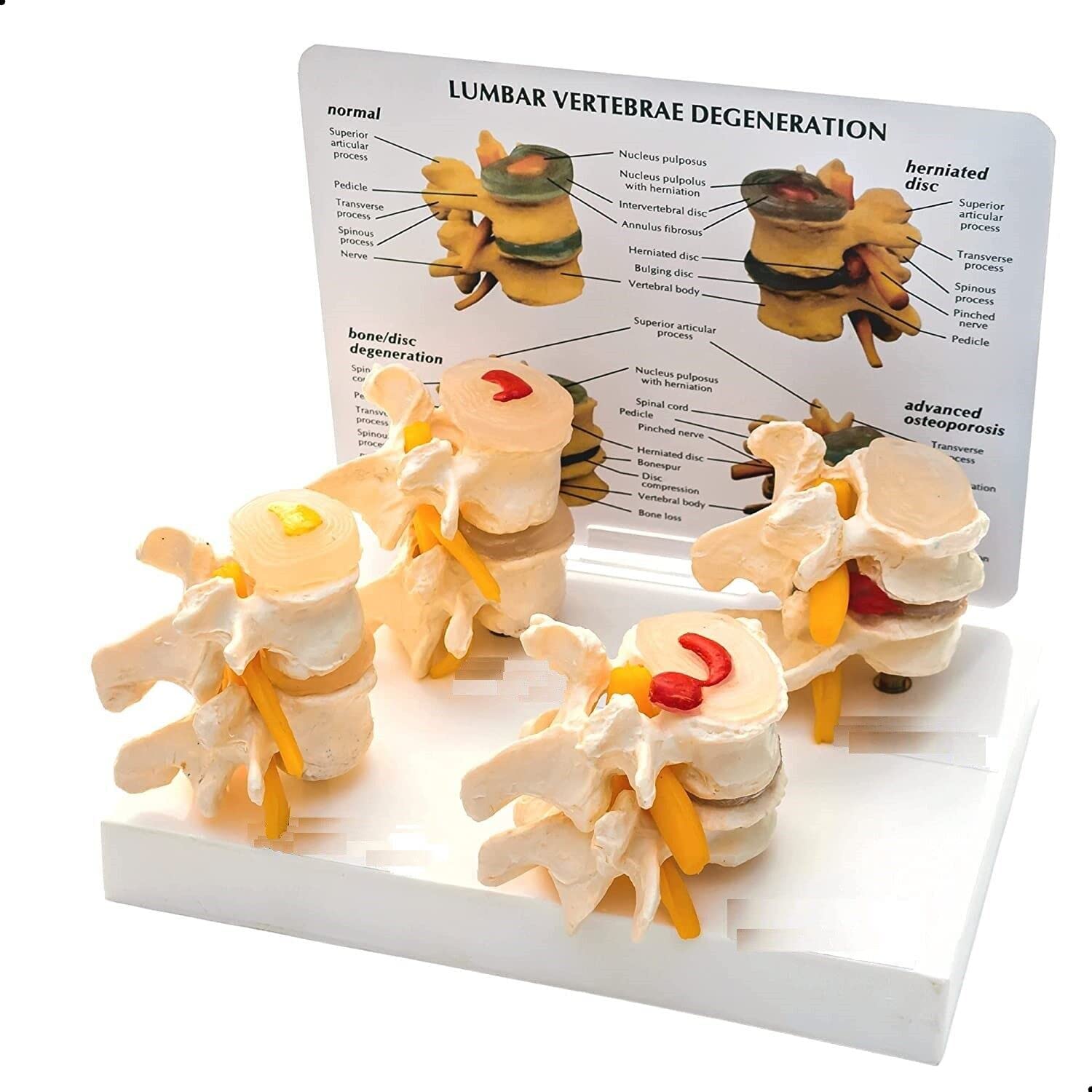 Saini MEDICOS 4 Stage DISC Degeneration Spine Model PVC Plastic, VERTEBRAE Degeneration Model