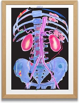 MEDPAPERS Abdominal CT Angiography Art Print Interventional Radiology Vascular Surgery Medical Office Decor 8.5x11 in A4