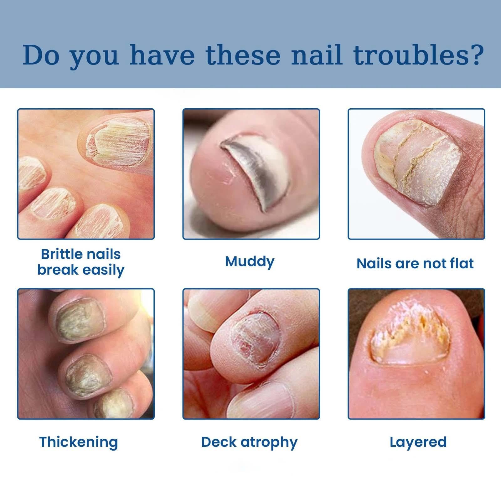 A Speedy and Effective Approach to Toenail Issues - Combating Thick, Discolored Nails - Powerful Solution for Addressing Yellow and Brown Nails - Image 2