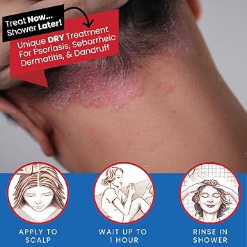 Tarsum Extra Strength Psoriasis Shampoo - Coal Tar Shampoo and Conditioner for Scalp Psoriasis, Seborrheic Dermatitis, Severe Dandruff, Eczema - Exfoliating Relief for Flaky, Itchy Scalp (8 oz)