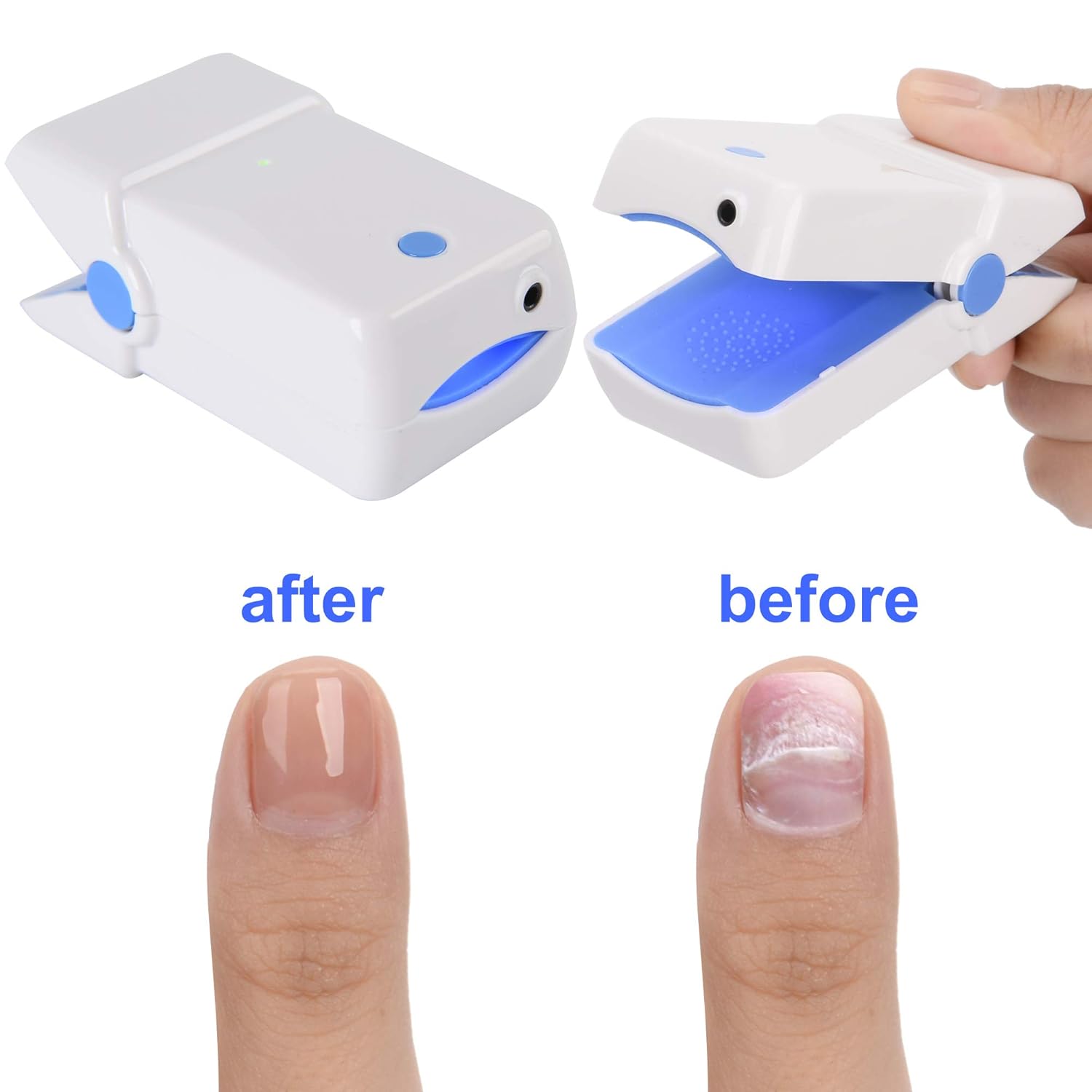 MAGNETOE Portable Nail Therapy Treatment Device For Toes And Fingernails, December 2022 Edition