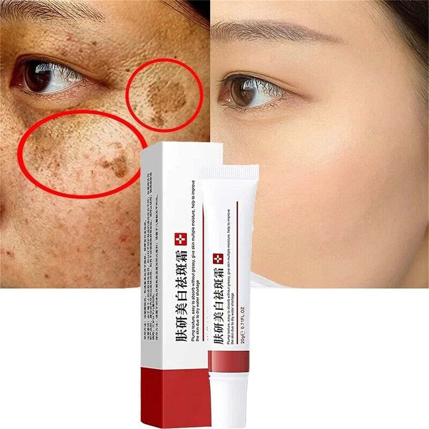 whitening freckle cream acne scar removal treatment cream pigmentation removal cream for face anti-wrinkle moisturizing anti-blemish effective remove melasma melanin dark spots 2 pieces