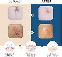 Vista 2 de Scarbandit Cinta de silicona para cicatrices – Hojas de cicatrices para eliminación de protuberancias queloides, abdominoplastia, cesárea