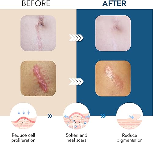 Miniatura 2 de Scarbandit Cinta de silicona para cicatrices  Hojas de cicatrices para eliminación de protuberancias queloides, abdominoplastia, cesárea, quemaduras