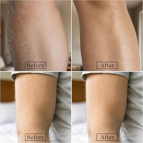 Miniatura 5 de Danliss Crema de urea 60 por ciento para pies, máxima fuerza más ácido salicílico 2% crema para pies y manos para talón agrietado seco, loción de