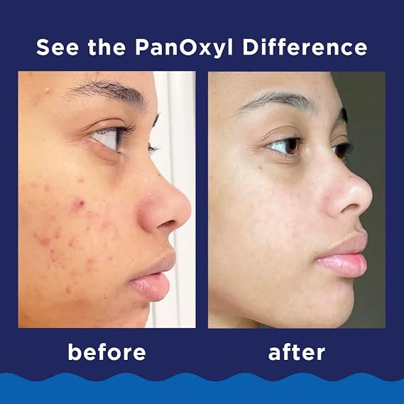 PanOxyl 10% Acne Foaming Wash 5.5 Ounce (Value Pack of 2)
