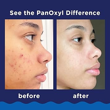 PanOxyl 10% Acne Foaming Wash 5.5 Ounce (Value Pack of 2)