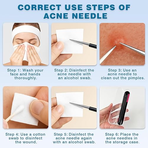 Miniatura 3 de Kit de herramientas para eliminar puntos negros, juego de 4 piezas de acero inoxidable para acné y espinillas, extractor de espinillas y espinillas