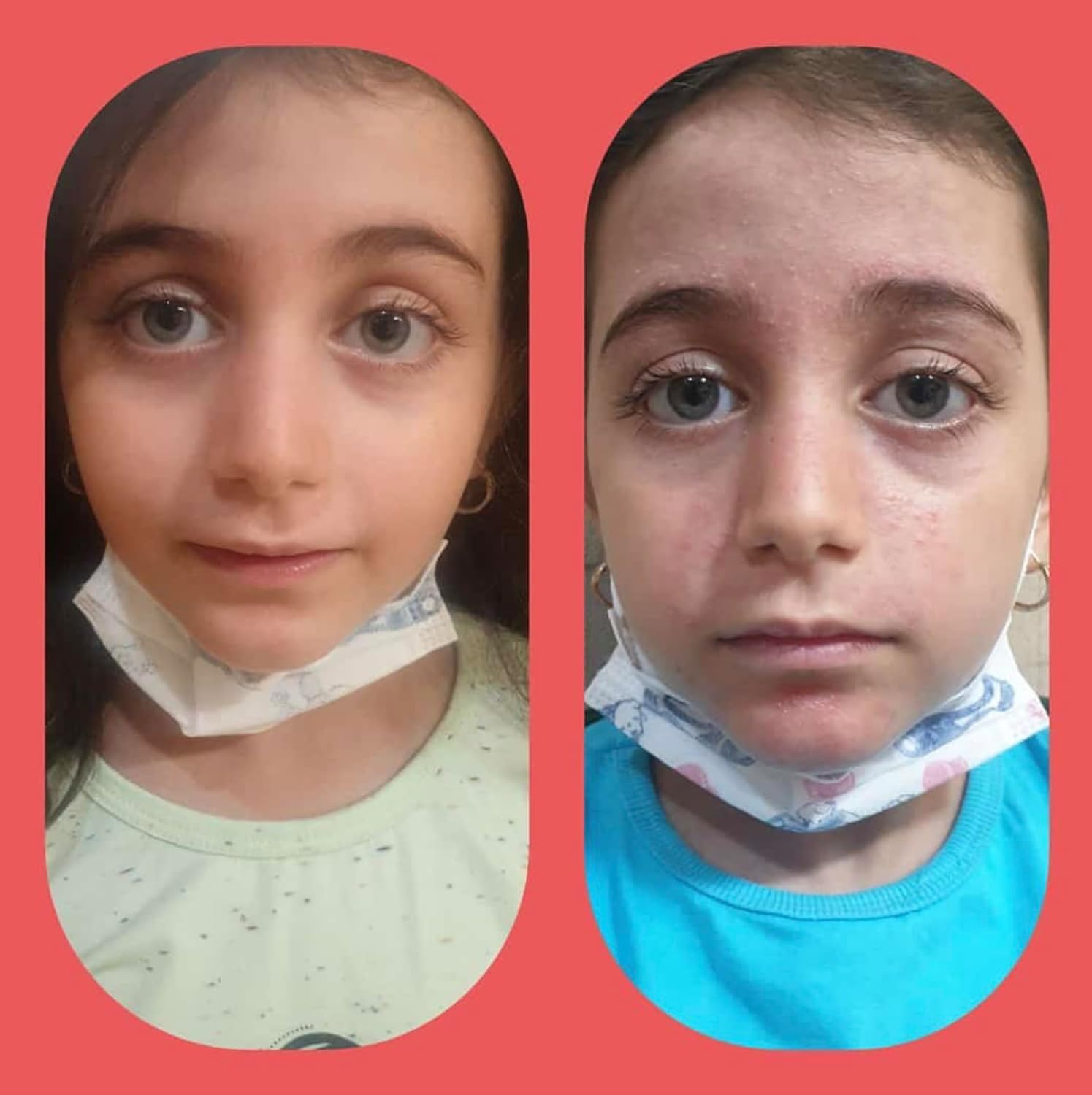 Demodexcillin Skin Solution 4.0 Fl.Oz. Recommended for Rosacea, Acne, Belpharitis & Seborrheic Dermatitis