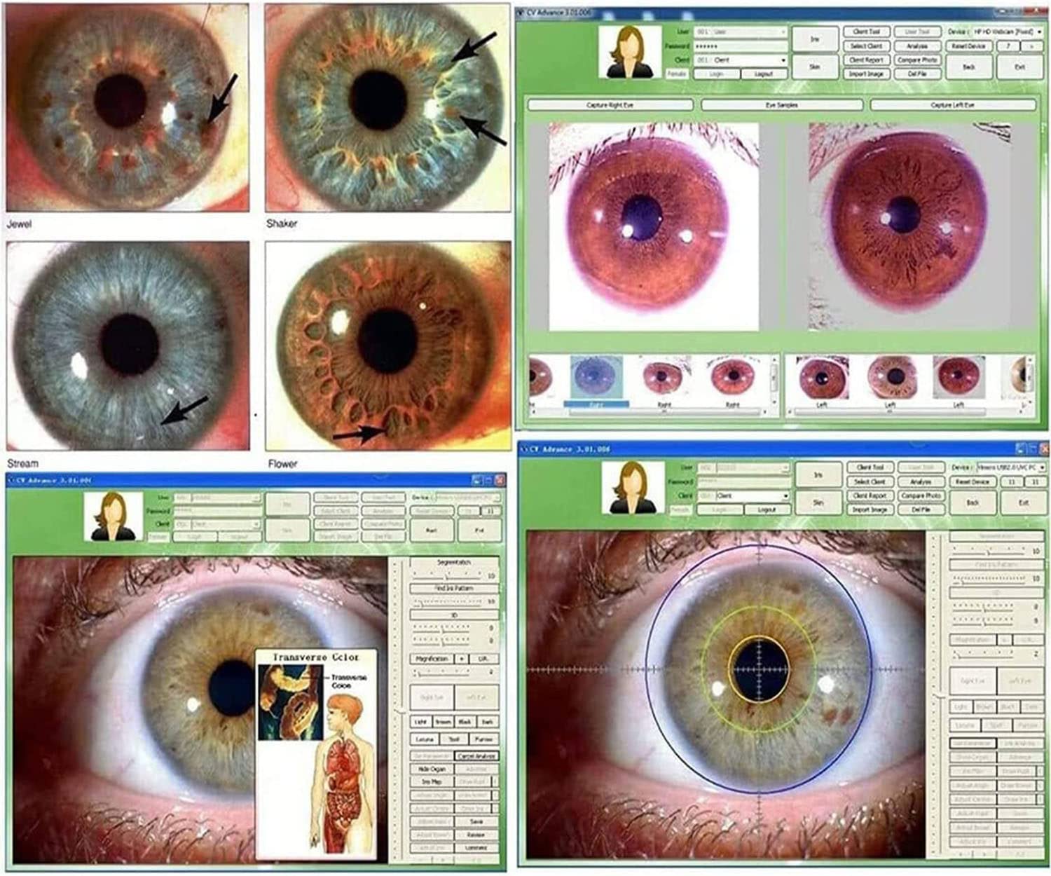 Kamera analizy IRIS,5 milionów pikseli wysokiej rozdzielczości 2560 * 1920 USB2.0 Interfejs Iriscope Diagnostic Eye Camera,z pojedynczym podwójnym sterowaniem lampy regulowaną Win7,Win8, Win10, Win11
