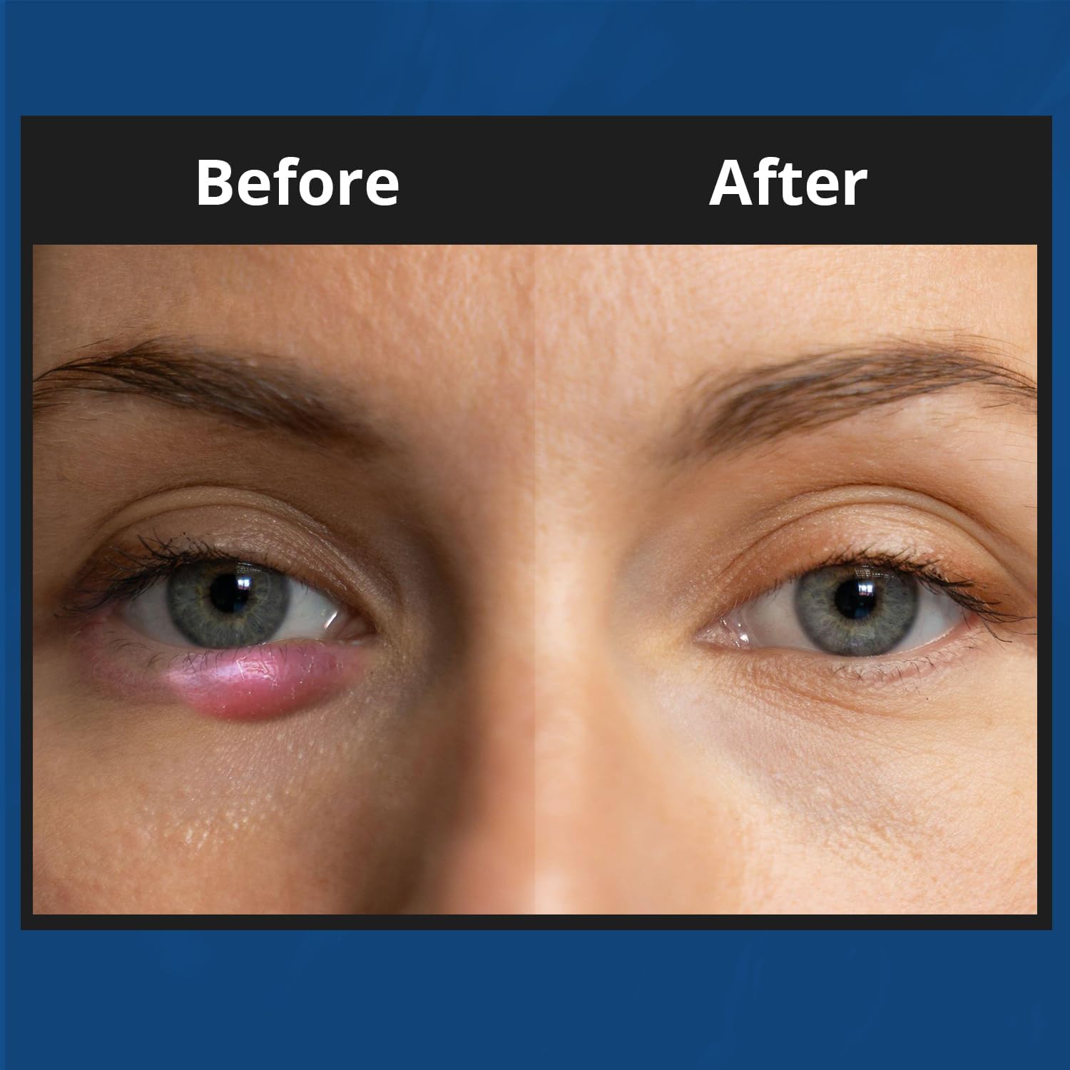 NOVEHA XStye Eyelid Foaming Cleanser - Fast Stye Eye Relief - Formula With Tea Tree Oil - Daily Eyelid and Eyelash Wash For Stye Eyes, Eyelash, & Skin Dryness (3.38 fl oz) - 3PK - 100mL - Image 4